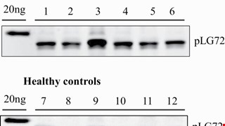 Diagnosing Alzheimer's Disease Specifically and Sensitively With pLG72 and Cystine/Glutamate Antiporter SLC7A11 AS Blood Biomarkers img