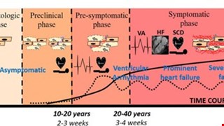 Pathogenesis of Arrhythmogenic Cardiomyopathy: Role of Inflammation img